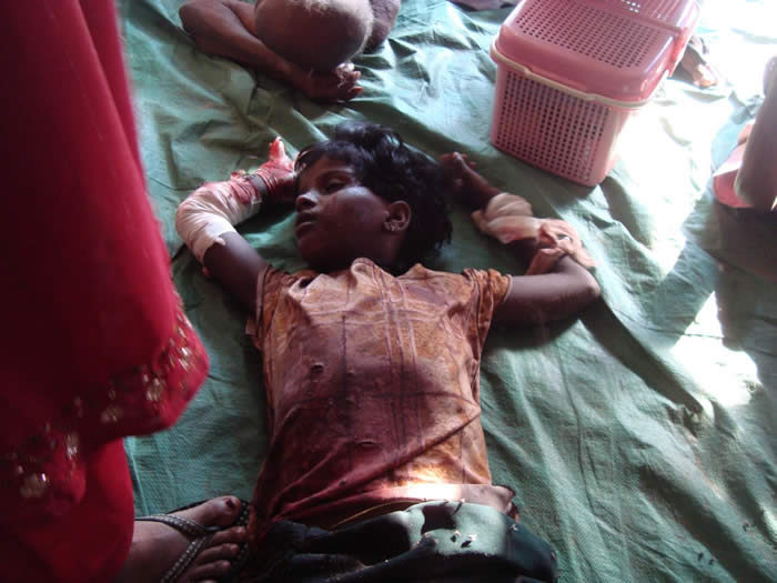 Child injured in 'Safe zone' by Sri Lankan army shelling April 17, 2009